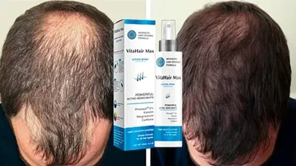 Minoxidil qué es esto - composición - ¿cómo usar - para que sirve - ingredientes