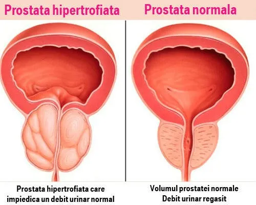 photo: Prostaffect - Türkiye, eczane, yorumlar, bu nedir, fiyat, nereden alınır, resmi sitesi